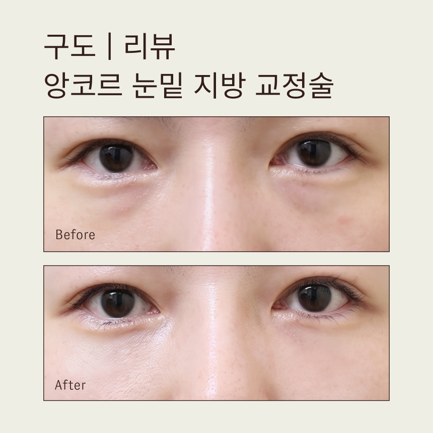 구도 앙코르 눈밑 지방 교정술ㅣ답답한 인상 개선 솔루션