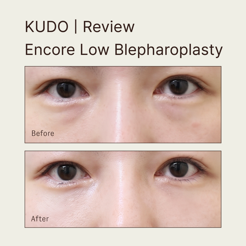 KUDO Encore Low Blepharoplasty | Solution for a More Refreshed Look