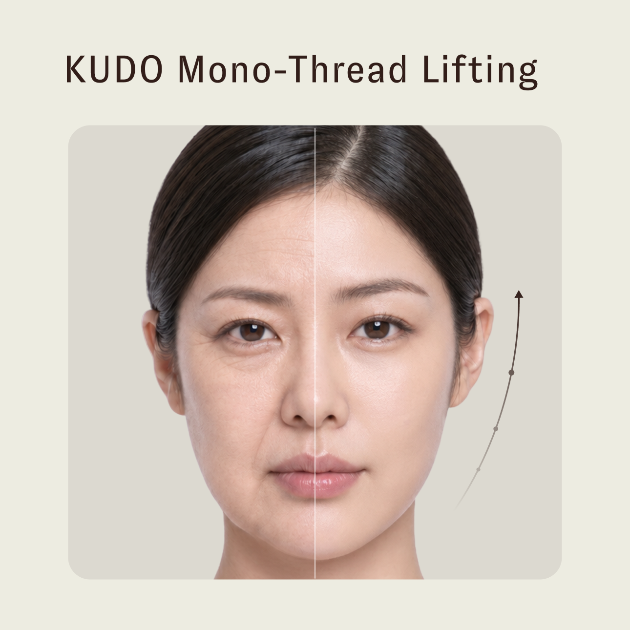 KUDO Mono-Thread Lifting | The Essence of Collagen Remodeling