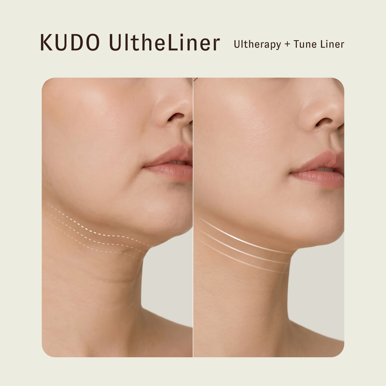KUDO UltheLiner | Precision Lifting Through Two Distinct Ultrasound Technologies
