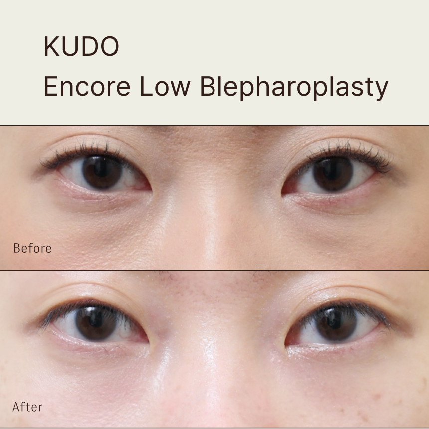 KUDO Encore Low Blepharoplasty