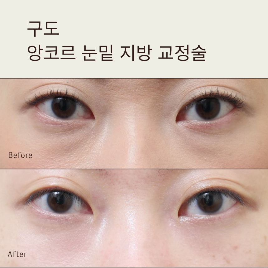 구도 앙코르 눈밑 지방 교정술