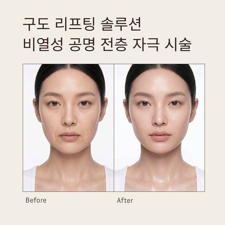 구도 리프팅 솔루션 | 비열성 공명 전측 자극 시술